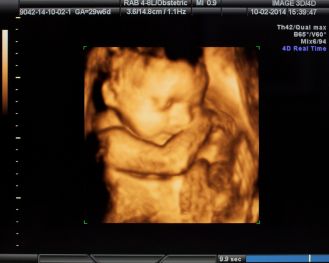 Ultrasound 3D/4D